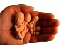 Abortion